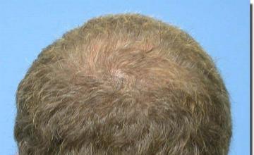 Hair restoration procedure results