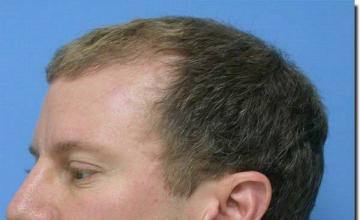 Hair restoration procedure results