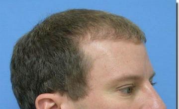 Hair restoration procedure results