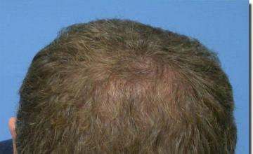 Hair restoration procedure results