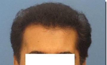 Hair restoration procedure results