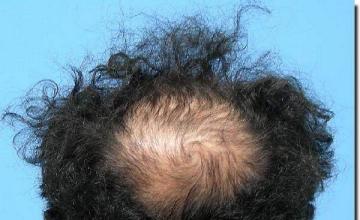 Hair restoration procedure results