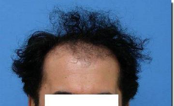 Hair restoration procedure results