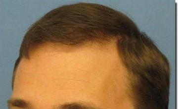 Hair restoration procedure results