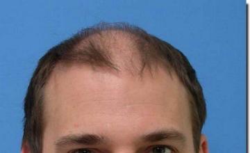 Hair restoration procedure results