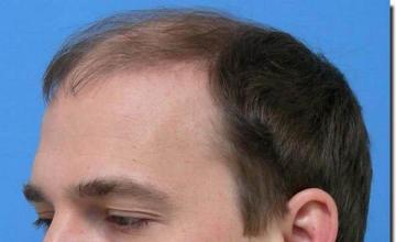 Hair restoration procedure results