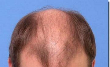 Hair restoration procedure results