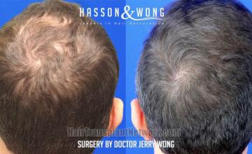 Surgical hair transplantation result photographs