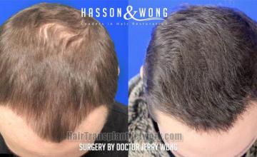 Hair transplantation surgery before and after images