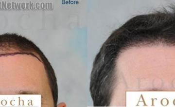 Hair restoration procedure before and after results