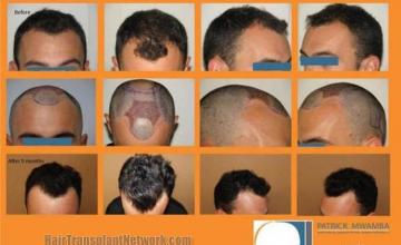 Before and after hair transplant procedure images