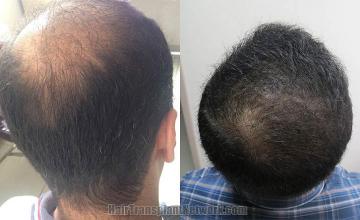 Hair transplantation surgery before and after pictures