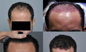 Hair transplantation surgery before and after pictures