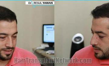 Hair transplantation surgery before and after photos