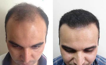 Hair restoration procedure before and after results