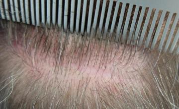 Hair transplant surgery before and after images