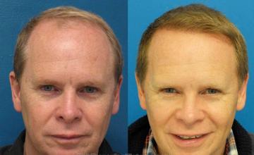 Hair restoration procedure before and after results