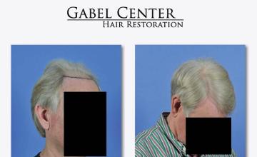 Hair transplant surgery before and after photos