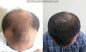 Hair transplantation surgery before and after photos