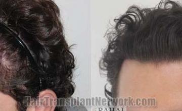 Hair transplantation surgery before and after images