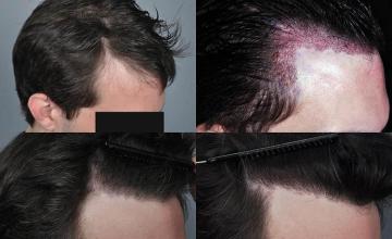 Hair restoration procedure before and after results