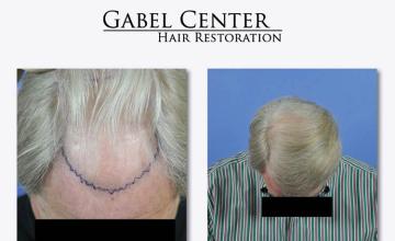 Top view before and after hair restoration results