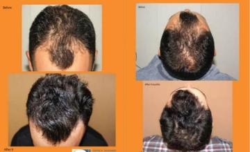 Hair restoration procedure before and after results