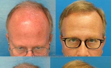 Hair restoration surgery before and after images