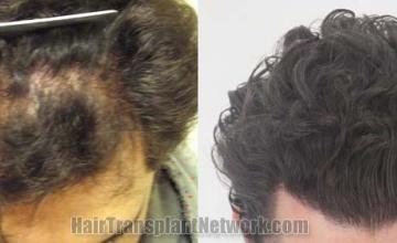 Hair restoration procedure before and after results