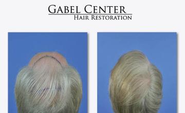 Hair transplantation surgery before and after photos