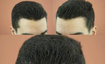 Hair transplantation surgery before and after pictures