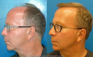 Hair transplantation surgery before and after pictures