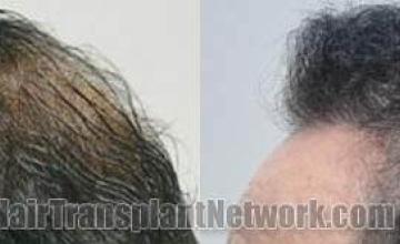 Hair transplantation surgery before and after pictures