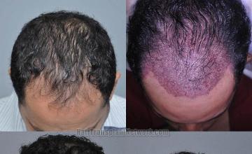 Hair restoration procedure before and after pictures