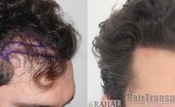 Hair transplantation surgery before and after photos