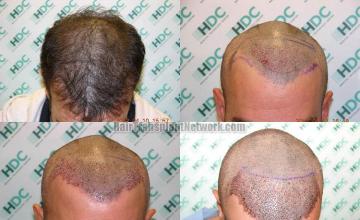 Hair restoration procedure before and after results