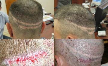 Hair transplantation surgery before and after pictures