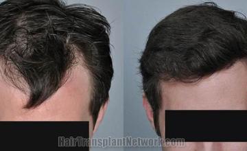 Before and after hair transplantation result photographs