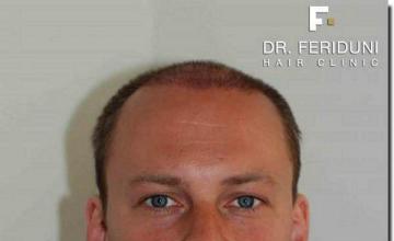 Hair restoration procedure results