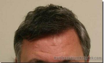 Hair restoration procedure results