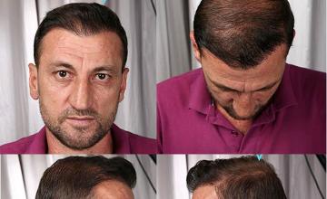 Hair restoration procedure results