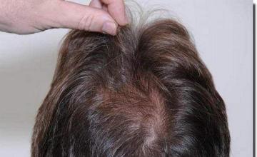 Hair restoration procedure results