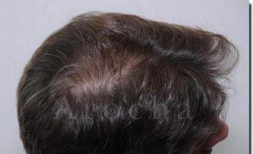 Hair restoration procedure results