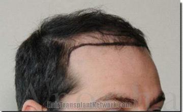 Hair restoration procedure results