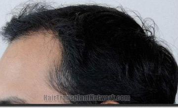 Hair restoration procedure results