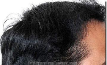 Hair restoration procedure results