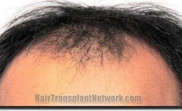 Hair restoration procedure results