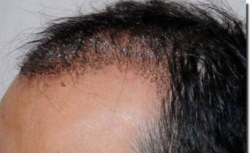 Hair restoration procedure results