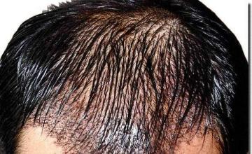 Hair restoration procedure results