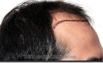 Hair restoration procedure results